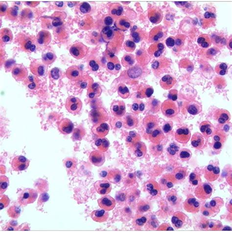 Endoscopic presentation of the eosinophilic gastroenteritis patients on ...