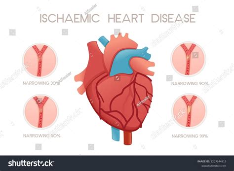 Unhealthy Human Heart Ischemic Disease Anatomy Stock Vector Royalty