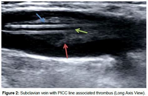 PICC Line Thrombosis