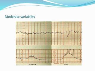 Intrapartum Fetal Heart Rate Assessment PPT