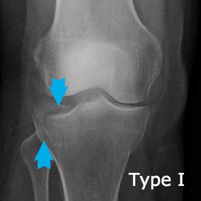 Tibial Plateau Fracture Classification Quantitative D Measurements