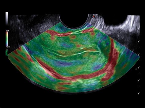 Gynaecology Ultrasound Clinical Solutions - Esaote