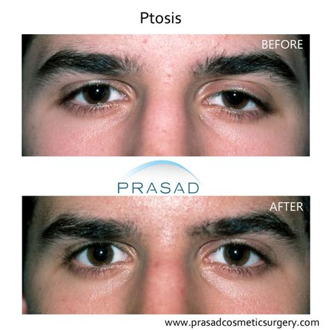 Droopy Eyelid Before And After