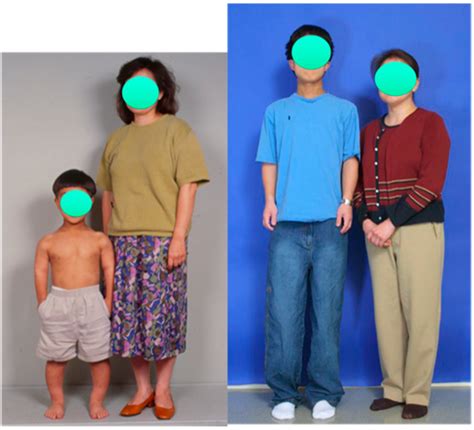 Extensive Limb Lengthening for Achondroplasia and Hypochondroplasia