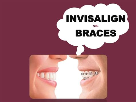 Ppt Expert Cosmetic Dentist In Elk Grove For Braces And Invisalign