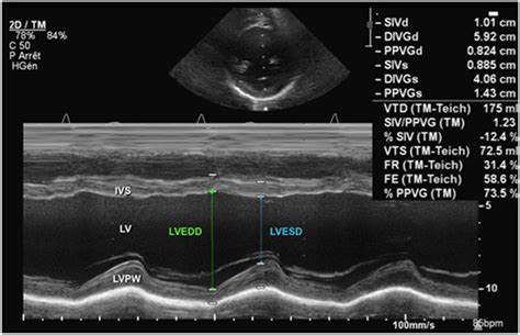 Frontiers Echocardiographic Evaluation Of Ventricular Function—for