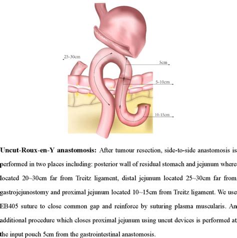 Schematic diagram of gastrointestinal anastomosis. | Download ...