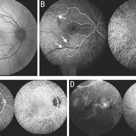 (PDF) Treatment controversies in a rare case of a simultaneous branch retinal artery and vein ...