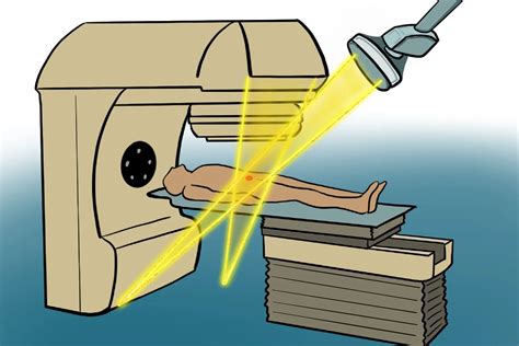 What is radiation? - Colontown University