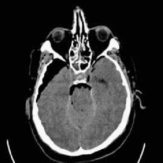 Non Contrast Axial CT Scan Demonstrating Pneumocephalus Causing