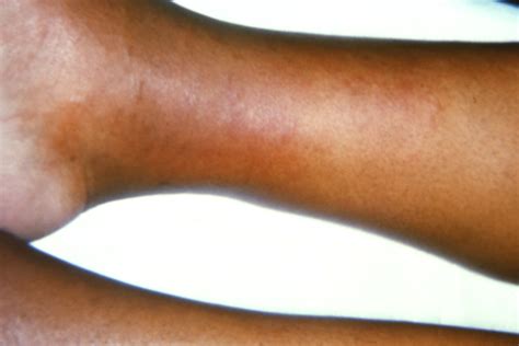 Phlebitis Arm Treatment