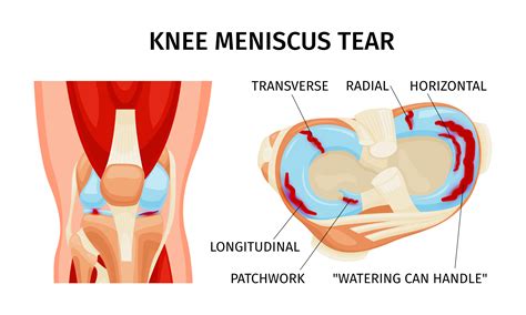 How To Heal A Torn Meniscus Naturally ProHealth Prolotherapy Clinic