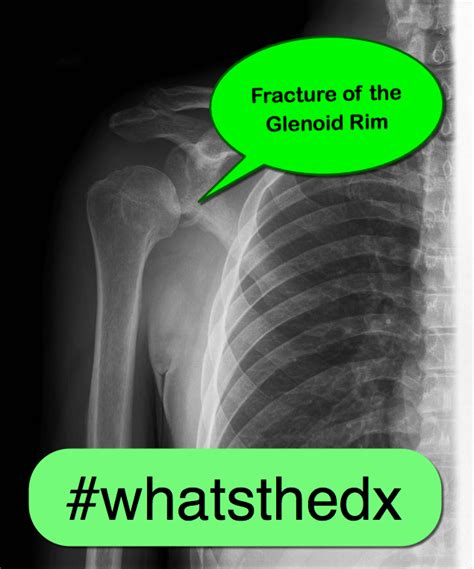 Glenoid Fossa Fracture