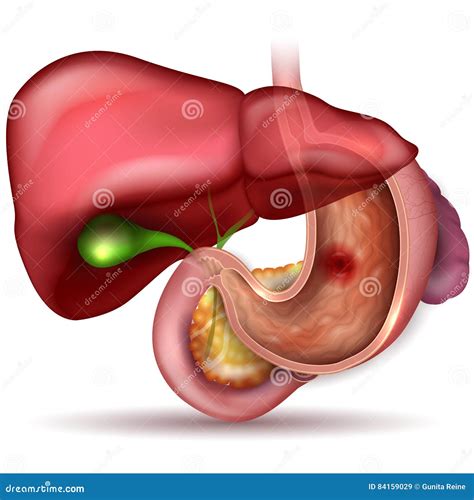 Esophagus Ulcer Affected. Ulcer Of Esophagus Vector Illustration ...