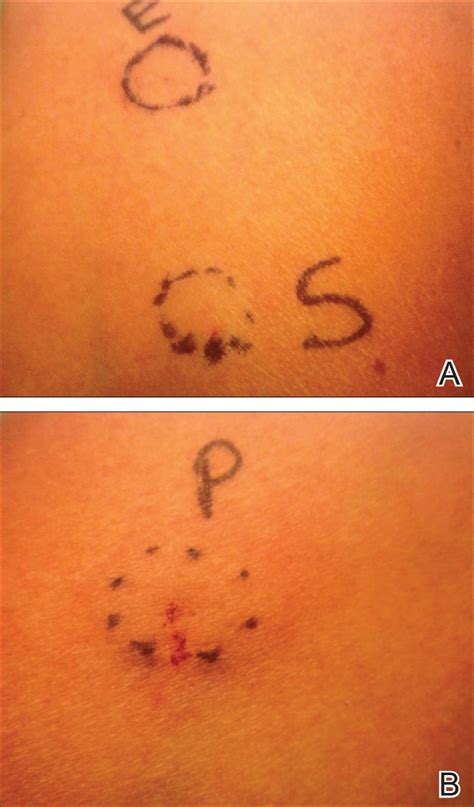 Autoimmune Progesterone Dermatitis | MDedge Dermatology