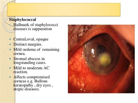 Bacterial Corneal Ulcer