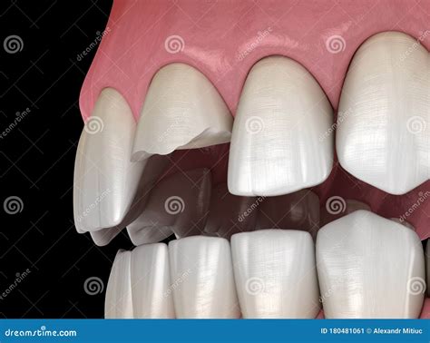 Broken Central Incisor Tooth. Medically Accurate 3D Illustration of ...