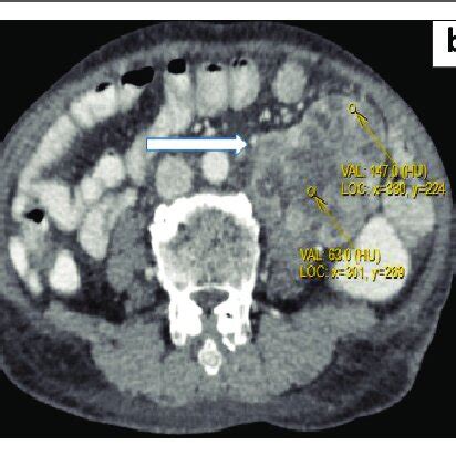 A C Ultrasound Abdomen Showing Retroperitoneal Mass Of Heterogeneous