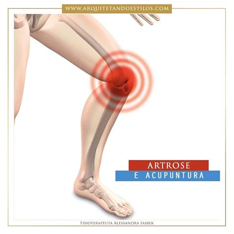 Artrose O Desgaste Da Cartilagem Que Recobre Os Ossos De Uma