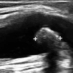 -Ultrasound image of Baker's cyst. The cyst is oval and located deep in... | Download Scientific ...