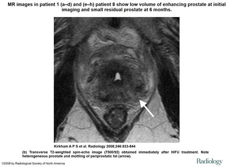 Prostate biopsy | Leaders in Pharmaceutical Business Intelligence (LPBI ...