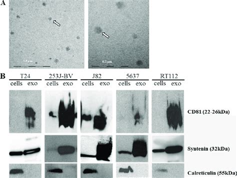 Ubc Cells Secrete Exosomes A Tumor Associated Exosomes Obtained From