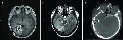 Imaging Before LITT A Axial Postcontrast T1 Weighted MRI Showing