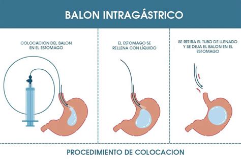 Balón Gástrico Dra Liceaga