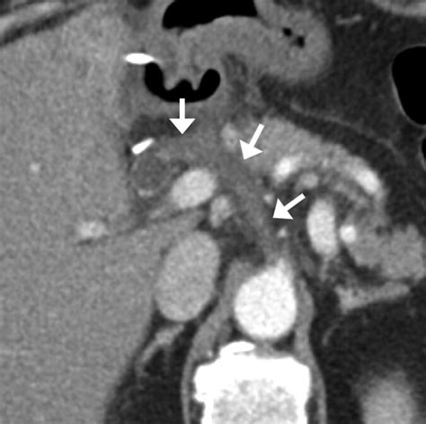 Contemporary Imaging Of The Surgically Placed Hepatic Arterial Infusion