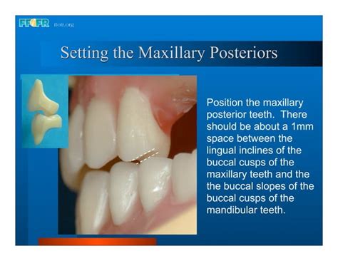 Complete Dentures 16occlusal Schemes Lingualized Occlusion