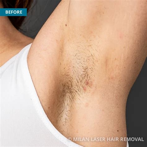 Laser Hair Removal Underarm Before And After