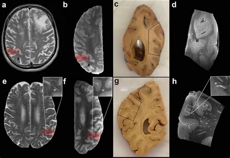 In Depth Characterization Of Mri Visible Perivascular Spaces Pvs Top