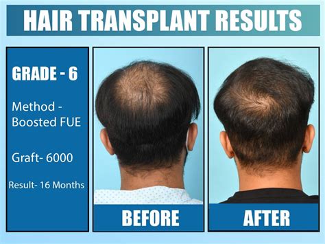 Hair Transplant Before After Result 16 Month Grade 6 Baldness With