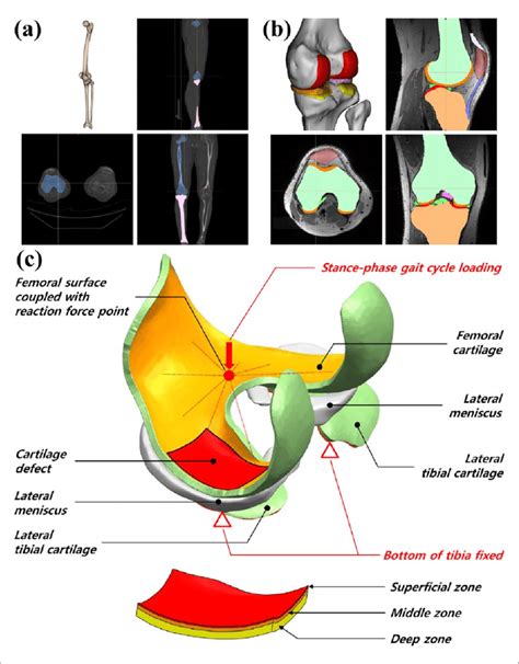 3D Knee Model Developed From A CT For Bone Reconstruction And B MRI