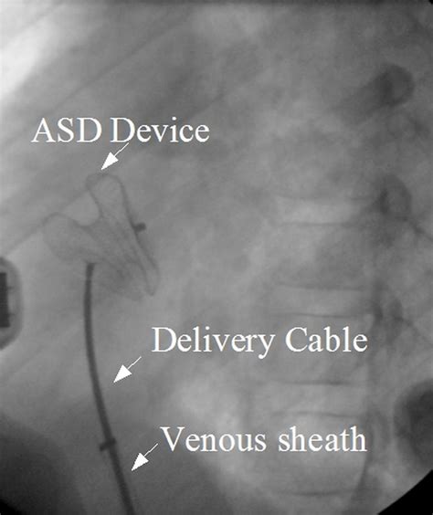 Device closure of atrial septal defect (ASD) – All About Cardiovascular ...