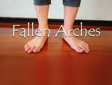 COLLAPSED ARCHES OR FEET? - barefeetpodiatry