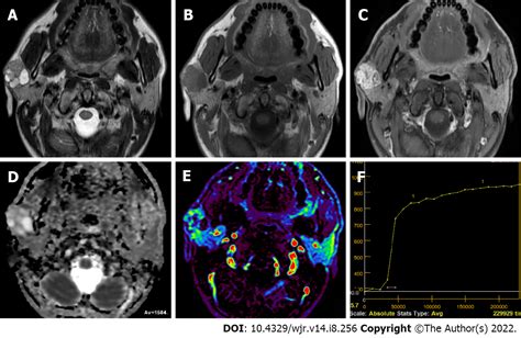 Parotid Gland Tumor Mri