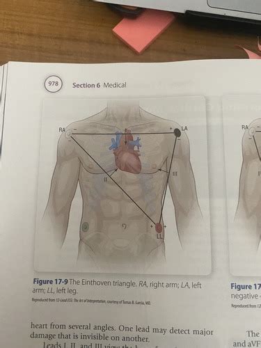 Ecg Stuff Flashcards Quizlet