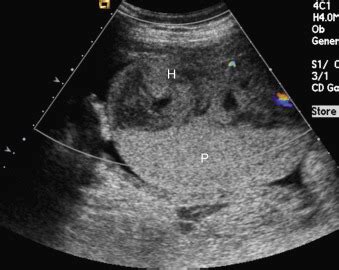 Placental Hemorrhage Ultrasound