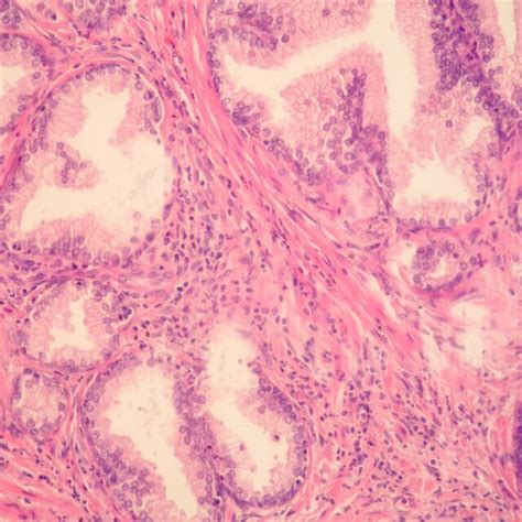 Benign Prostatic Hyperplasia Inflammatory Cells Mostly Mononuclears