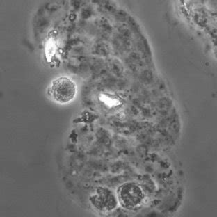 A renal tubular epithelial cell containing cast. Please note the renal ...