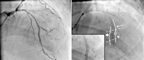 A Final Angiography After Third Drug Eluting Stents Terumo Nobori