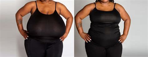 Breast Reduction Before And After