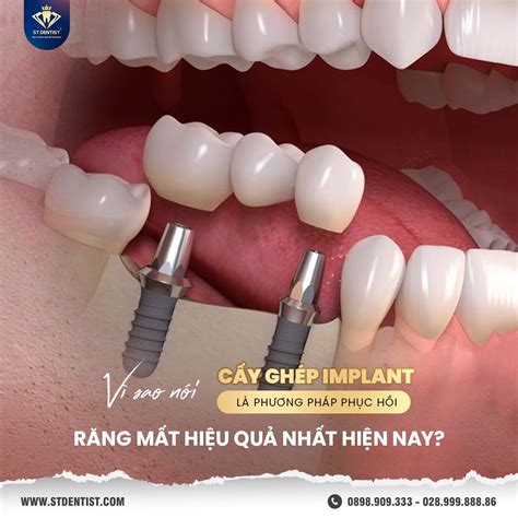 Kiến thức cấy ghép Implant