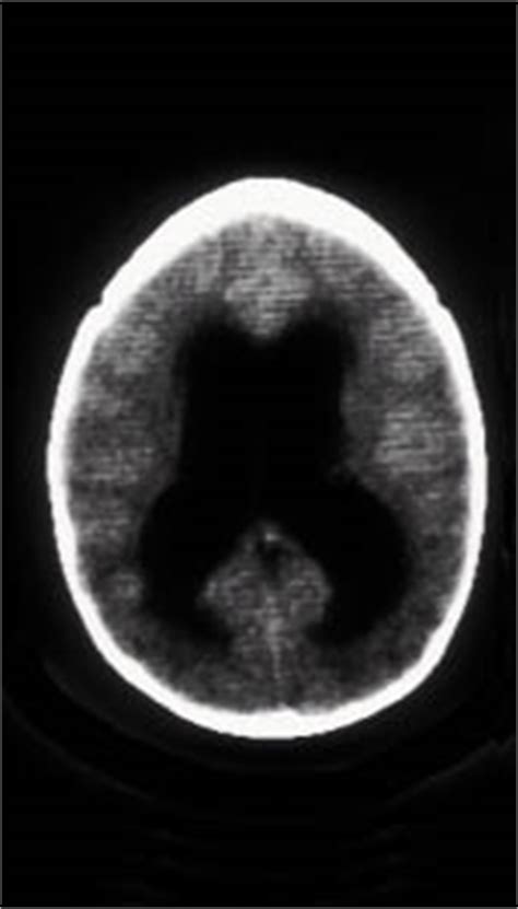 Tumores Cerebrales En Ni Os Pediatr A Integral