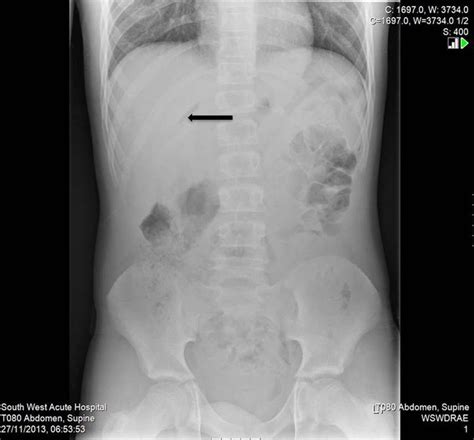 Atypical Presentation Of Perforated Peptic Ulcer Disease In A 12 Year