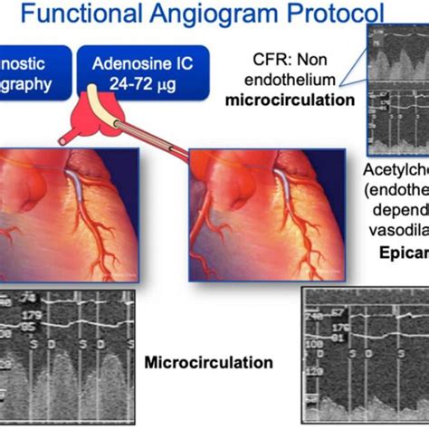 Coronary Angiography For Endothelial Function Assessment Coronary