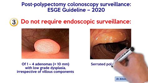 Post Polypectomy Colonoscopy Survellaince Esge Guidelines 2020 Hassan C Et Al Endoscopy