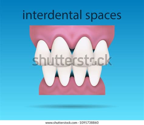 1 Veneer Gap Between Teeth Stock Vectors and Vector Art | Shutterstock