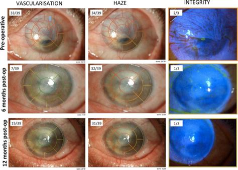 A Limbal Stem Cell Deficient Eye Graded By The Vascularization Haze